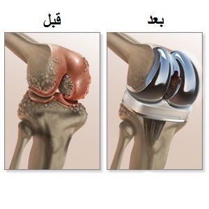 المفصل قبل وبعد جراحة تغيير مفصل الركبة