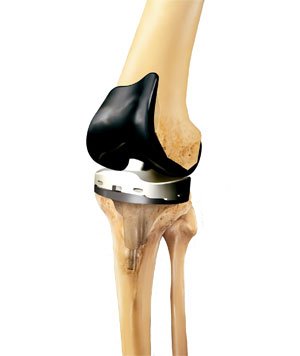 مفصل ركبة صناعي مخصص لمرضى السمنة