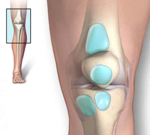 الالتهاب الكيسي (التهاب الجراب في الركبة)