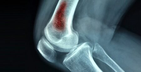 OSTEOMYELITIS