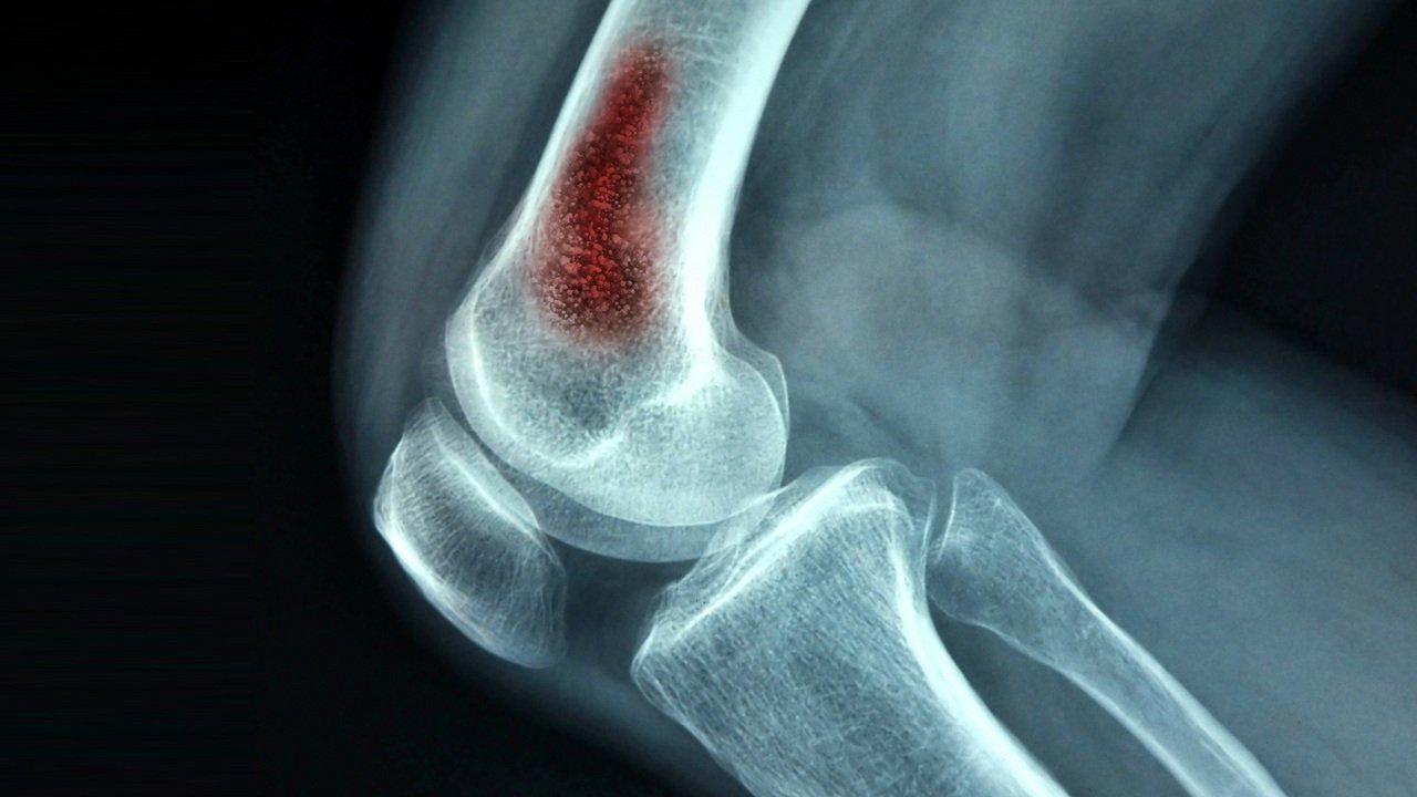 OSTEOMYELITIS