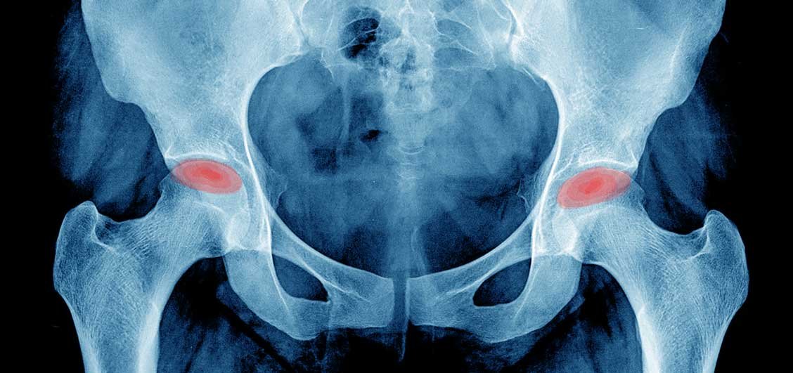 تنخر الفخذ اللاوعائي