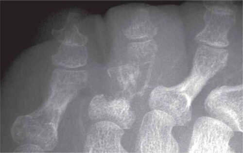 أشعة تظهر التهاب صديدي بأحد أصابع القدم