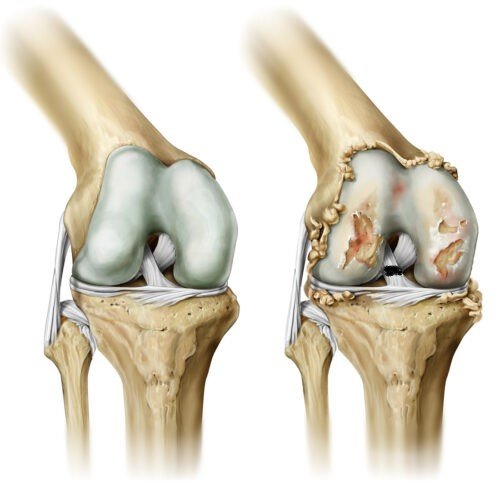  قطع الرباط الصليبي قد يسبب خشونة فى الركبة
