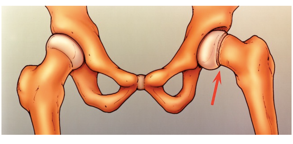 انزلاق رأس عظمة الفخذ