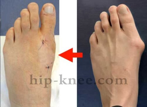 جراحة تصليح انحراف اصبع القدم الكبير من خلال جروح صغيرة