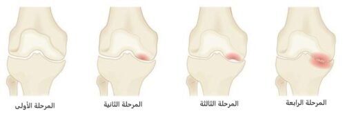 مراحل تنخر العظام في الركبة