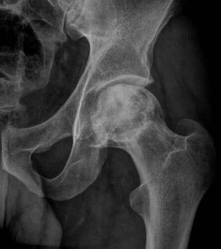 أشعة تظهر النخر العظمي في الحوض