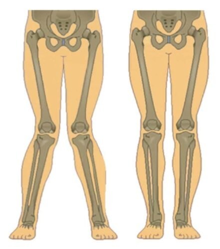 الركبة الرَّوحاء(أحد أنواع تقوس الساقين) بالمقارنة مع الركبة الطبيعية