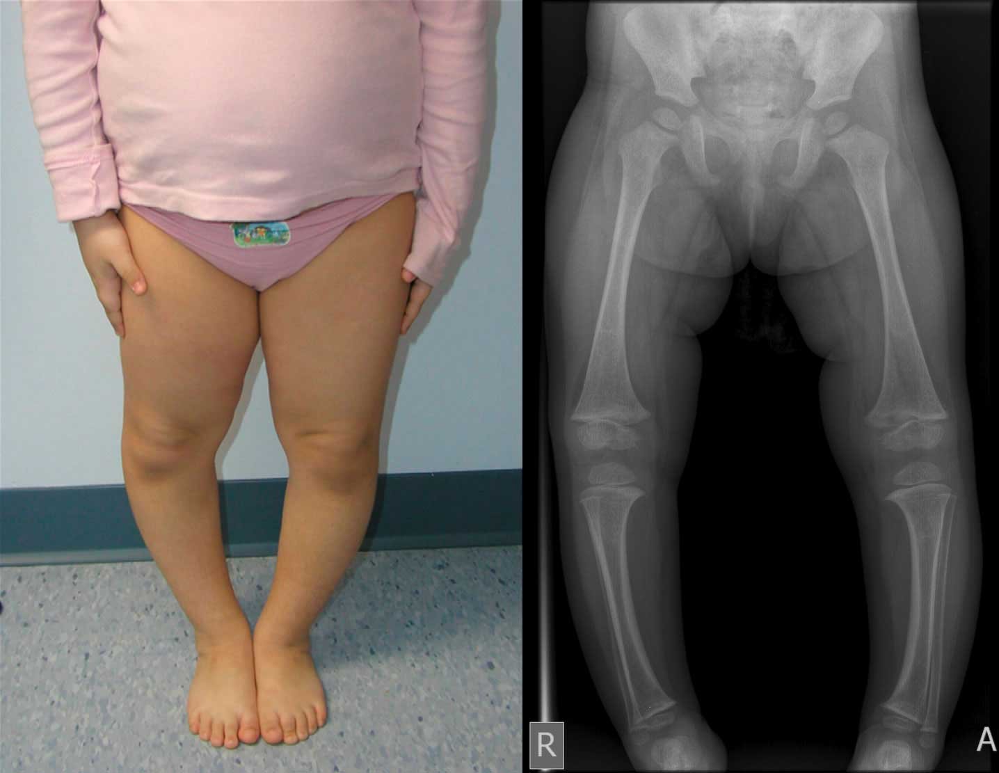 مرض لاونت و تقوس الساق الاطفال