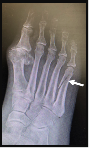 أشعة سينية تظهر كسور مشط القدم