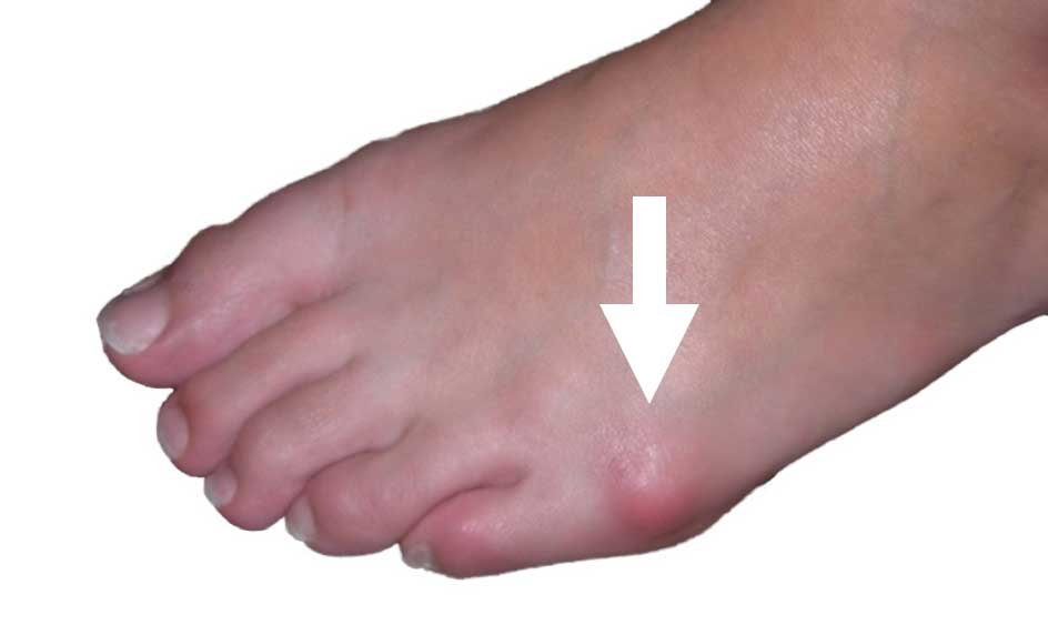 بروز-عظام-على-الجهة-الخارجية-للقدم