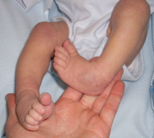 القدم الحنفاء (القدم المخلبية في الرضع)
