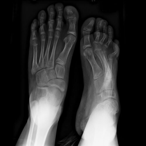 تشخيص القدم المخلبية من الأشعات