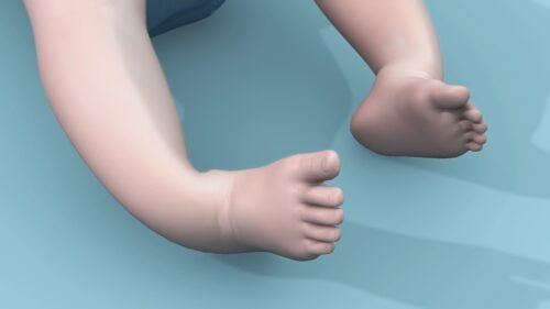 القدم المخلبية عند الرضيع