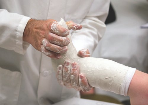 تجبيس القدم - علاج حنف القدم بطريقة بونسيتي