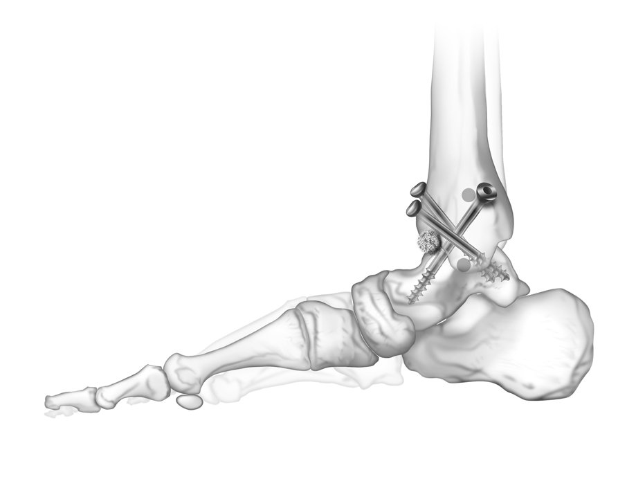 تثبيت و سمكرة مفصل الكاخل