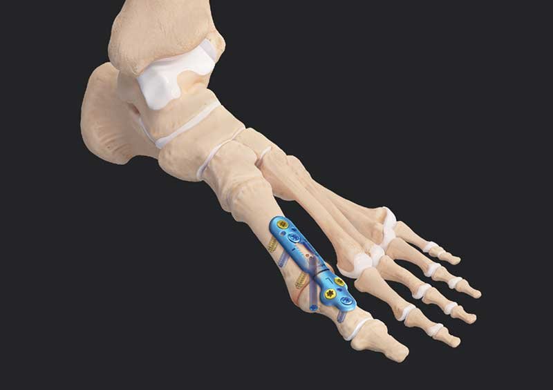 تثبيت (سمكرة) مفصل اصبع القدم الكبير