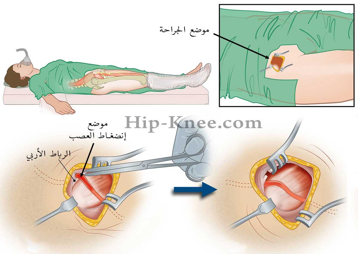 خطوات جراحة ألم الفخذ المذلي