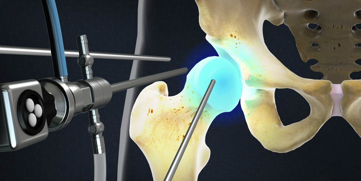 منظار الفخذ