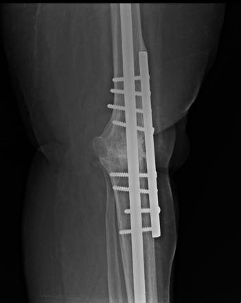أشعة توضح الشرائح والقضبان والمسامير المعدني في جراحة تثبيت الركبة