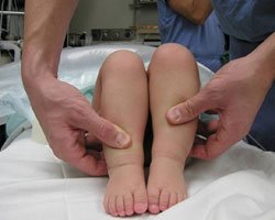 تباين طول الساقين في طفل مصاب بخلع الفخذ الولادي