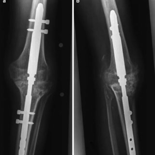 تثبيت مفصل ركبة أصيب بالالتهاب الصديدي بعد جراحة تركيب مفصل صناعي
