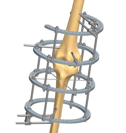 تثبيت مفصل الركبة باستخدام المثبت الخارجي اليزاروف