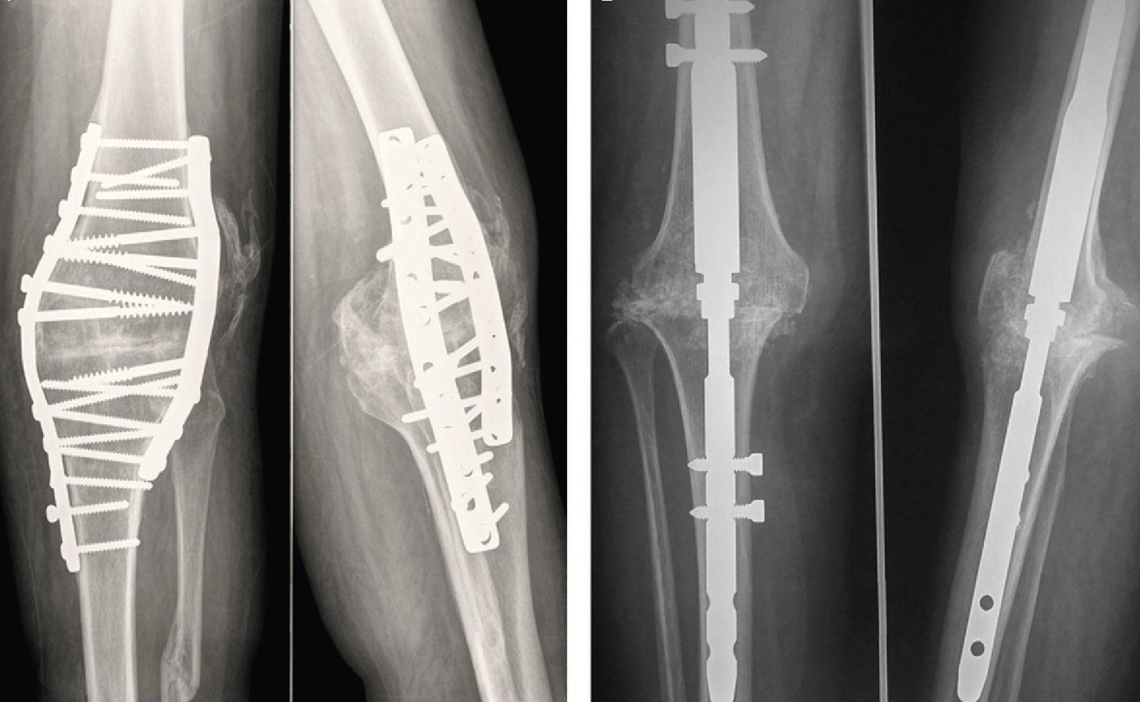 جراحة تثبيت مفصل الركبة (ايثاق الركبة)