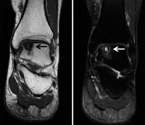 آفة الكاحل العظمية الغضروفية كما تظهر في أشعة الرنين المغناطيسي MRI
