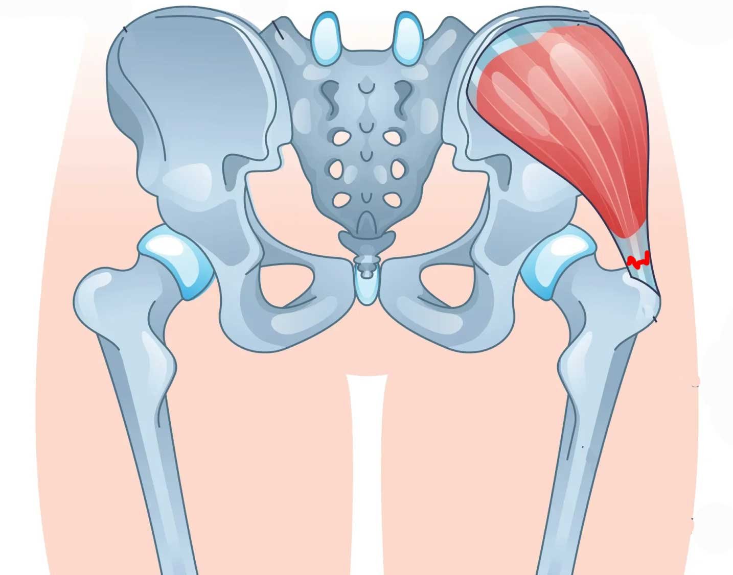 تكزق-عضلات-الأرداف-الجانبية