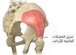 تمزق العضلة الجانبيه الألوية 