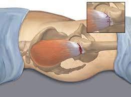 موضع تمزق الوتر الرابط بين العضلة وعظمة الفخذ