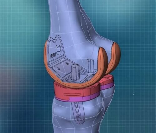 استخدام التصوير ثلاثي الأبعادفي جراحة استبدال الركبة، أحد التقنيات الجديدة