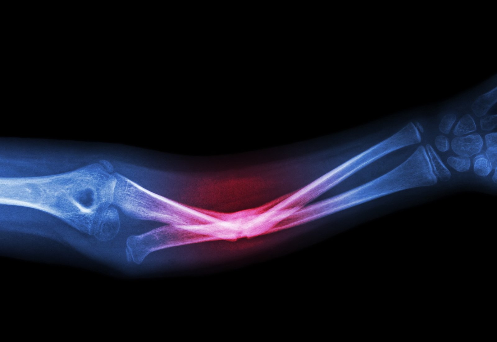 تأخر وعدم التئام كسور العظام