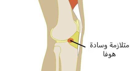 متلازمة وسادة هوفا