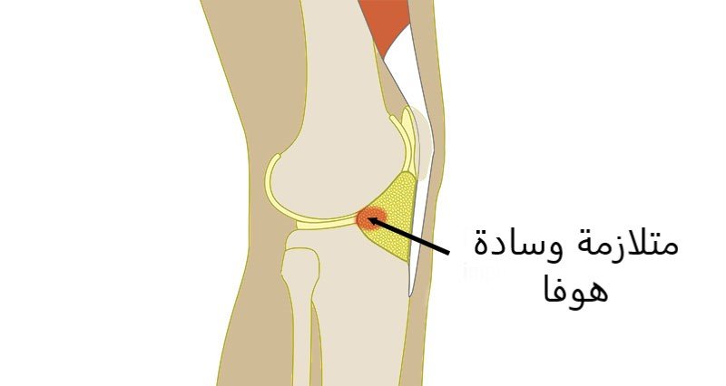 متلازمة وسادة هوفا