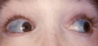 إزرقاق بياض العين نتيجة مرض العظام الزجاجية