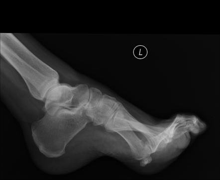 القدم الكهفية كما تبدو في الأشعة السينة