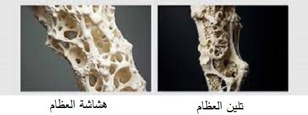 النسيج العظمي في حالتي هشاشة العظام وتلين العظام