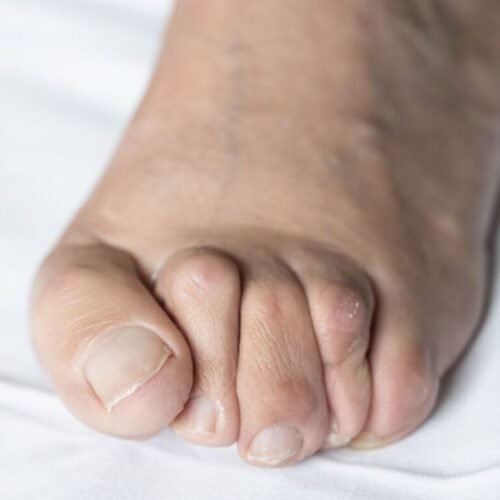 تشوهات أصابع القدم أحد أسباب التهاب تدويرة مشط القدم