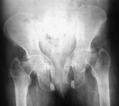 حالة تلين العظام كما تظهر في الأشعة السينية