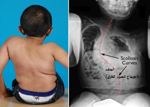 طفل مصاب بالجنف (إعوجاج العمود الفقري) أحد أعراض مرض العظم الزجاجي
