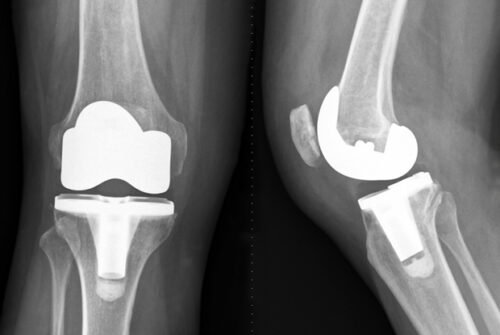 أشعة بعد إجراء جراحة تغيير مفصل الركبة الصناعي
