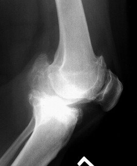 أشعة سينية توضح تشوه انثناء الركبة