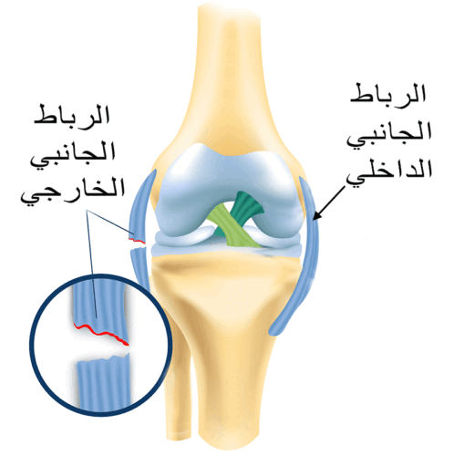 اصابة و قطع الرباط الخارجي للركبة