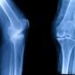 علاج خشونة الركبة المتقدمة بدون جراحة