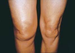 تورم الركبة أحد أعراض الحاجة لإجراء إعادة عملية الرباط الصليبي