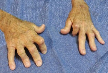 تشوه مفاصل الأصابع نتيجة التهاب المفاصل الصدفي