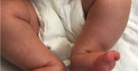 الكاحل العمودي الخلقي - Congenital Vertical Talus